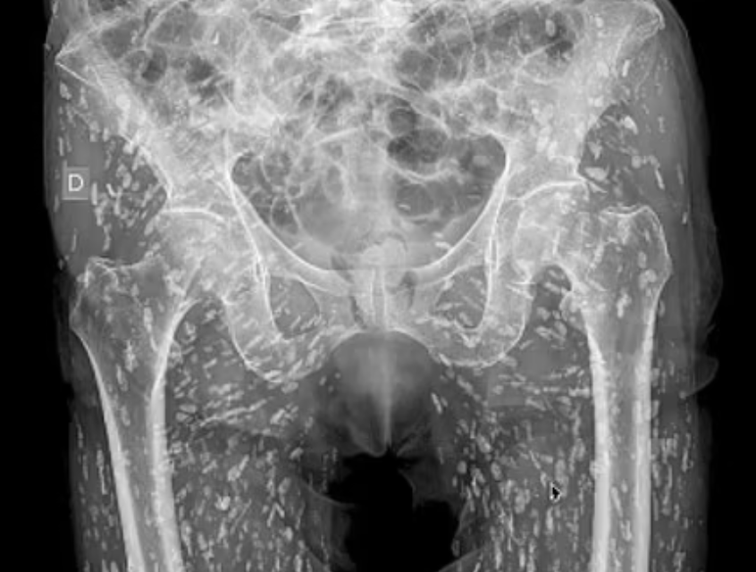 تناول لحم الخنزير النيء فكانت النتائج مرعبة