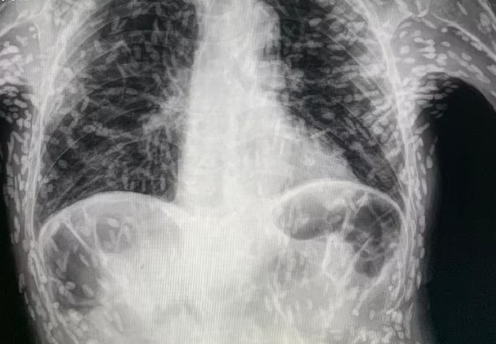 50 مليون شخص يصابون حول العالم كل عام