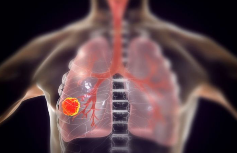 سر ارتفاع إصابات سرطان الرئة بين غير المدخنين «والنساء في الصدارة بنسبة 130%»