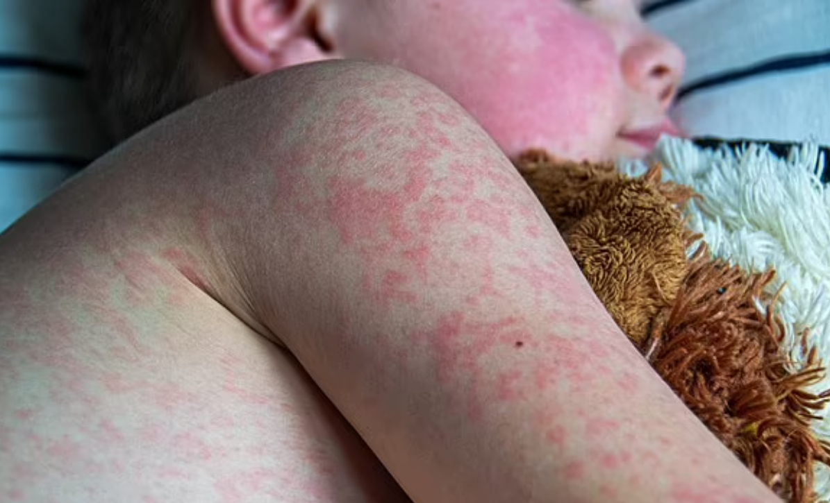 تفشي الحصبة في أمريكا يصل إلى مرحلة الرعب «14 ولاية تعاني من الإصابات»