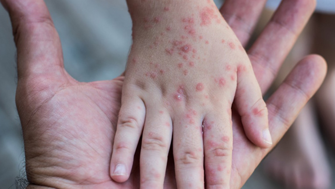 تفشي الحصبة في أمريكا يصل إلى مرحلة الرعب