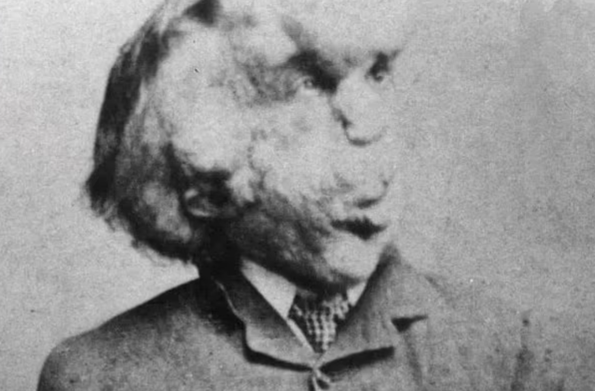 أمراض نادرة حول العالم