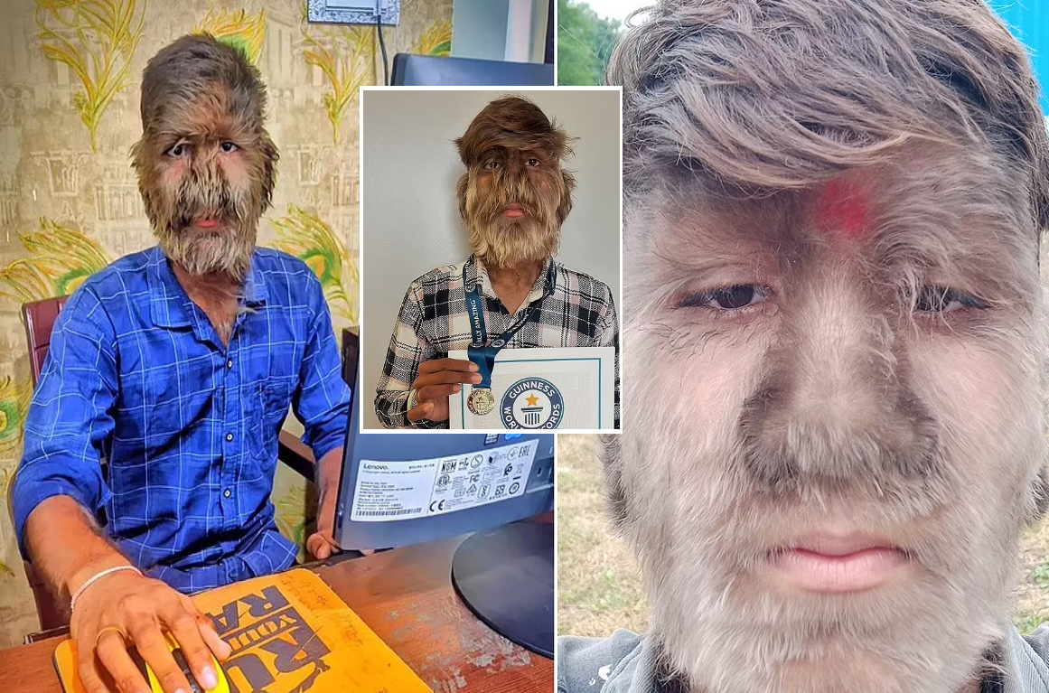 مصاب بـ «متلازمة الذئب» يحطم الرقم القياسي العالمي لأكثر وجه مشعر