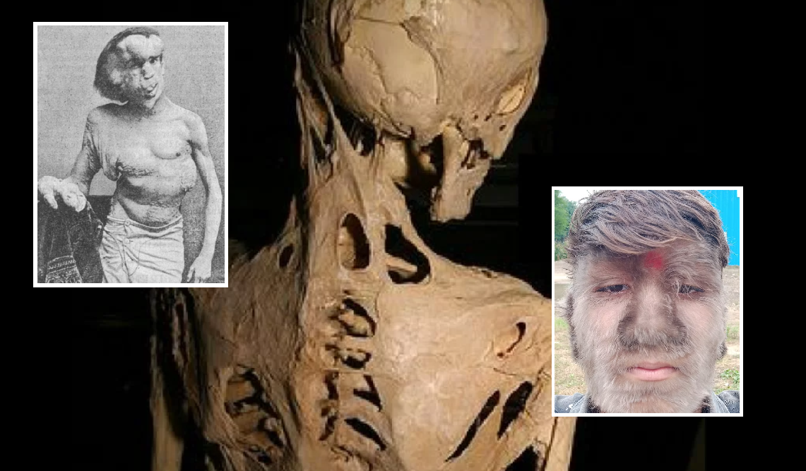 8 أمراض نادرة ضمن قائمة تصيب 350 مليون شخص حول العالم أغربها «الرجل الفيل والجثث المتحركة»