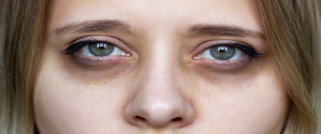 5 وصفات طبيعية للتخلص من الهالات السوداء.. أهمها« الشاي الأخضر»