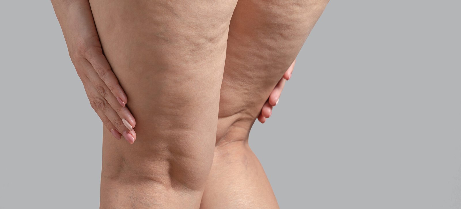 3 وصفات طبيعية فعّالة للتخلص من السيلوليت بطرق آمنة وسهلة