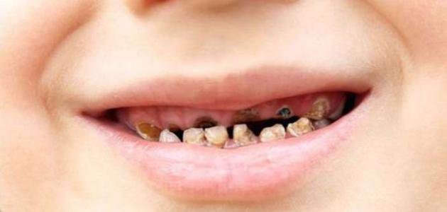 لماذا ينتشر تسوس أسنان الأطفال؟ الأسباب والحلول