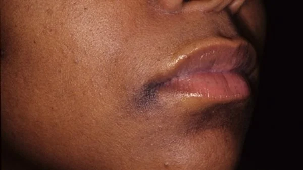 وصفات طبيعية تساعد على تفتيح منطقة الذقن لدى النساء