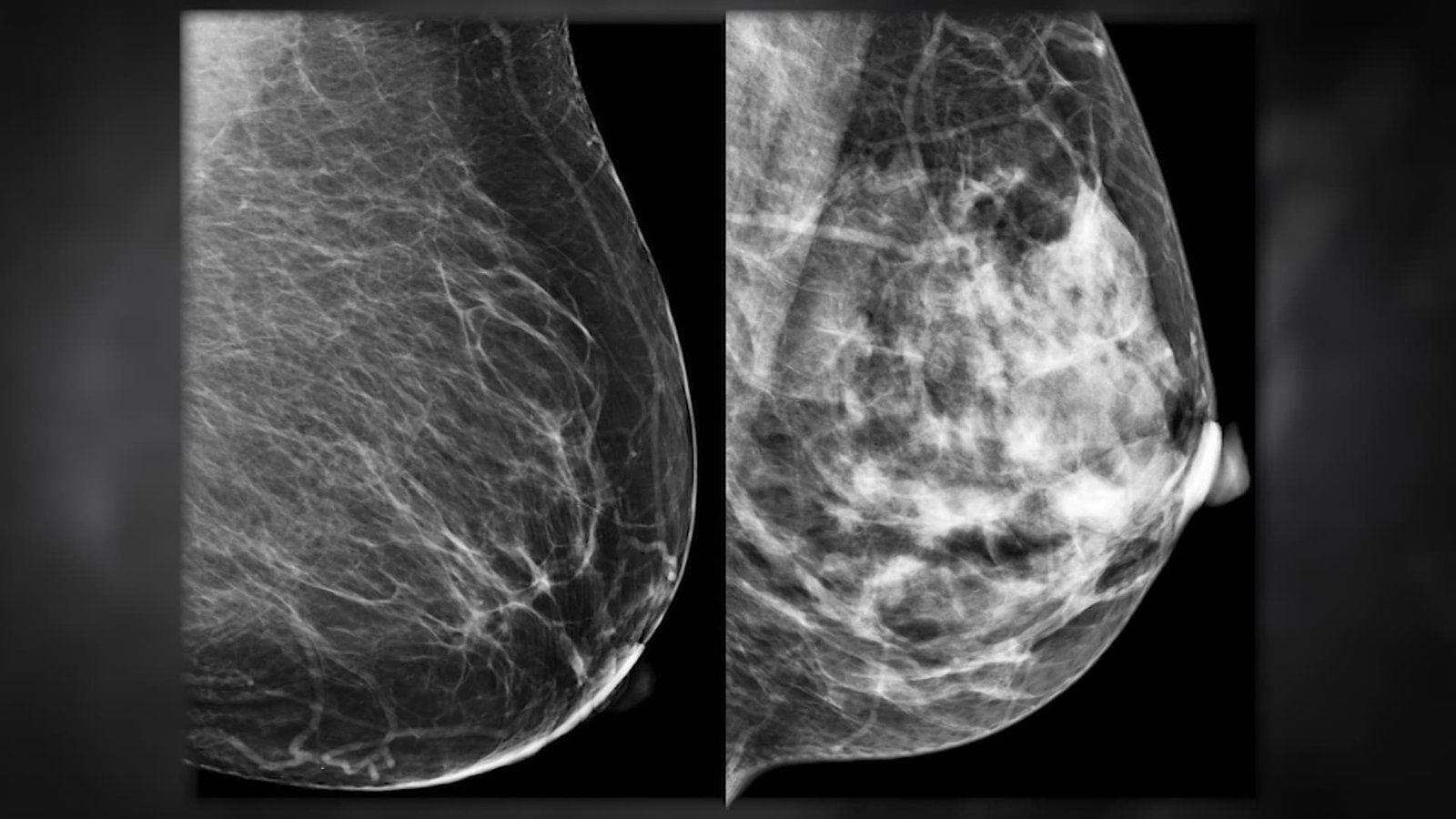 الذكاء الاصطناعي يتنبأ بسرطان الثدي قبل 5 سنوات من ظهوره… بدقة غير مسبوقة
