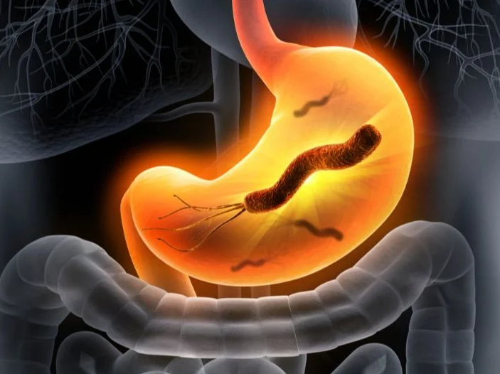 جرثومة المعدة... الأسباب والأعراض وطرق الوقاية والعلاج