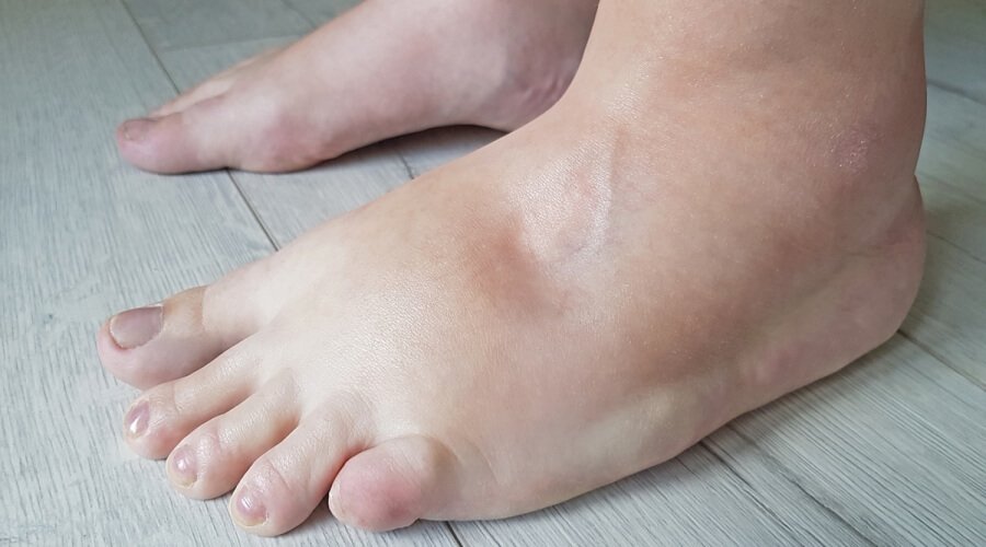 لماذا تتورم قدماك في الصيف؟ إليكِ الأسباب والعلاجات