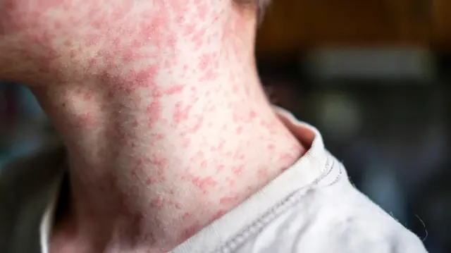 تفشي وباء قاتل في إسرائيل يثير القلق مع تصاعد الإصابات والوفيات بين الأطفال