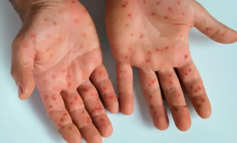 تفشي وباء قاتل في إسرائيل يثير القلق مع تصاعد الإصابات والوفيات بين الأطفال