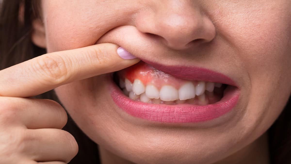 مركب نباتي طبيعي من قشور الفواكه قد يكون بديلاً للمضادات الحيوية في علاج أمراض اللثة