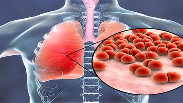 التهاب الشعب الهوائية.. مرض شائع يسبب السعال المستمر وقد يتحول إلى حالة مزمنة
