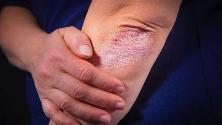 علاج ضوئي مبتكر قد يغيّر مستقبل علاج الصدفية