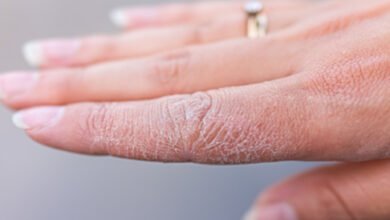 الإكزيما الشتوية.. لماذا تتشقق اليدان في البرد وكيف يمكن علاجها؟