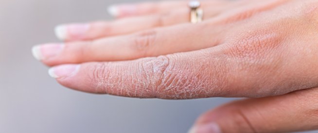 الإكزيما الشتوية.. لماذا تتشقق اليدان في البرد وكيف يمكن علاجها؟