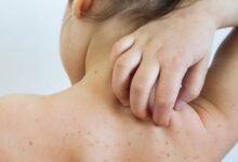 تحذير صحي: تراجع بسيط في التطعيم ضد الحصبة قد يرفع الإصابات بشكل كبير