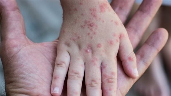 تحذير صحي: تراجع بسيط في التطعيم ضد الحصبة قد يرفع الإصابات بشكل كبير