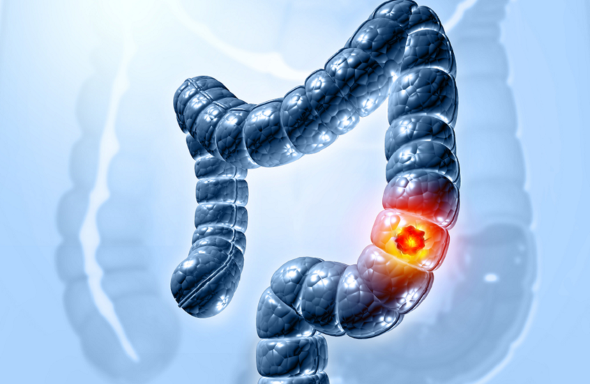 فجوة معرفية حول علاقة الغذاء بسرطان القولون والمستقيم