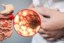 حمية قصيرة قد تخفف أعراض مرض كرون وتقلل الالتهاب