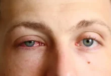 دراسة تربط فيروسًا بحريًا بمرض مزمن في العين لدى البشر