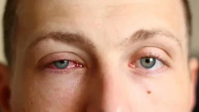 دراسة تربط فيروسًا بحريًا بمرض مزمن في العين لدى البشر